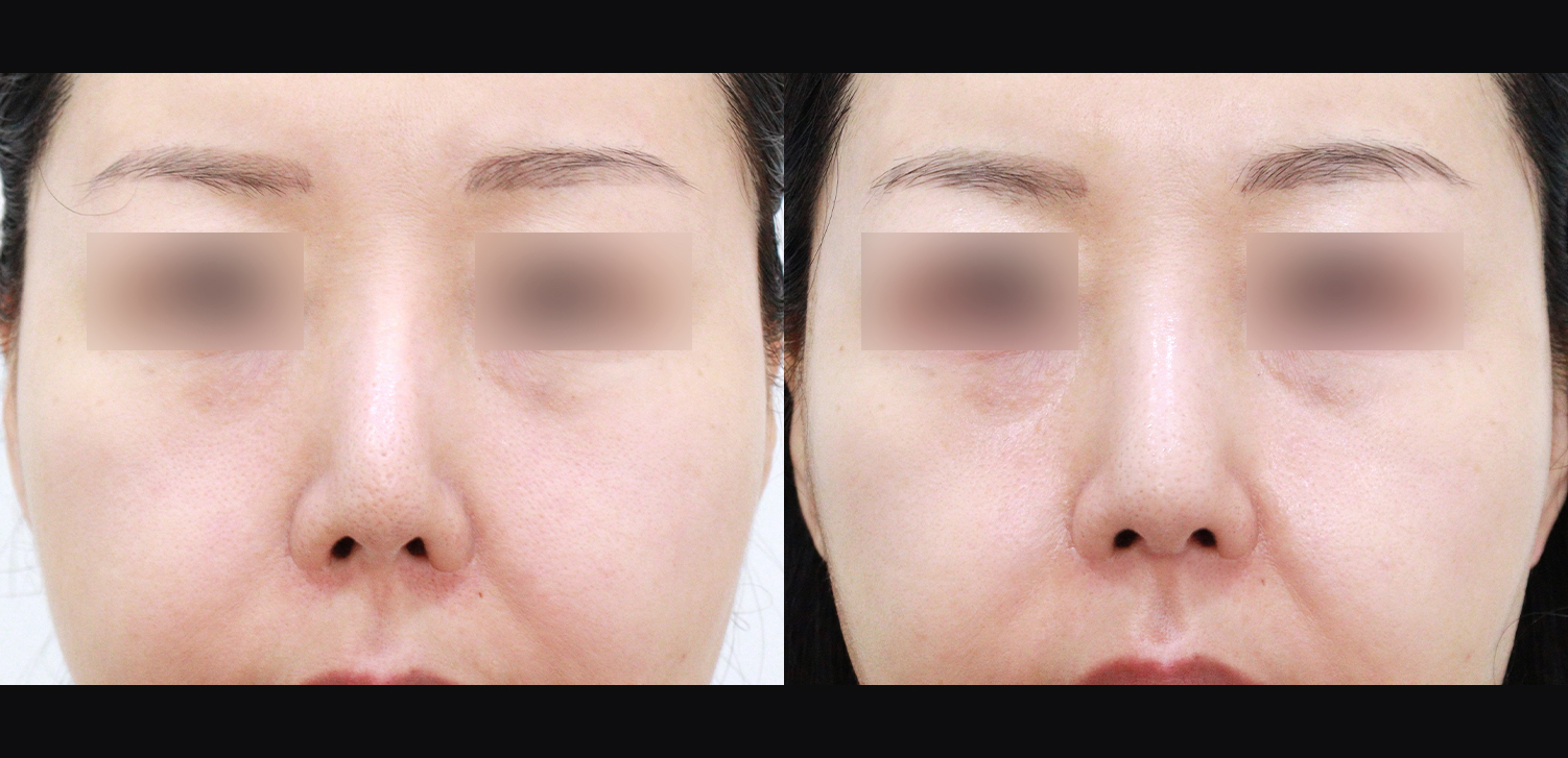 3D 코성형 재수술 (인중코+들창코+찝힌코+비중격재건+기능코)