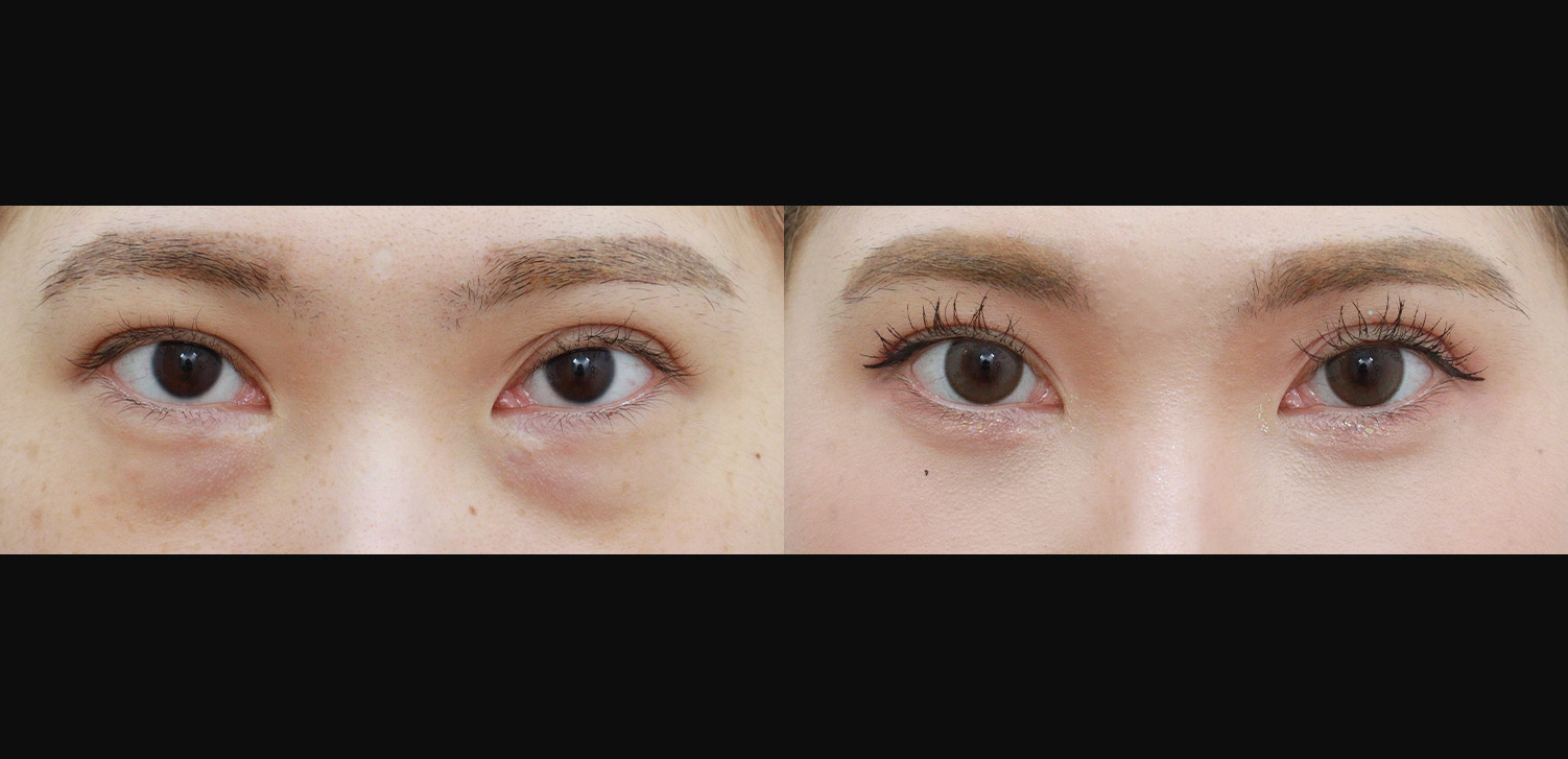 눈밑지방재배치