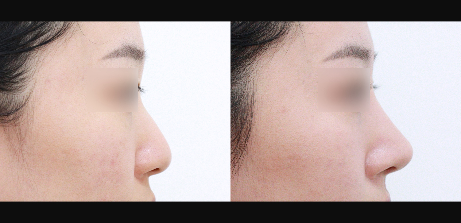 3D 코성형(콧대+코끝+인중코+기능코)